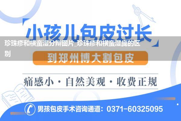 珍珠疹和横蛮湿分辩图片_珍珠疹和横蛮湿庞的区别